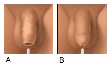 A. Intact Penis (not circumcised) and B. Circumcised Penis